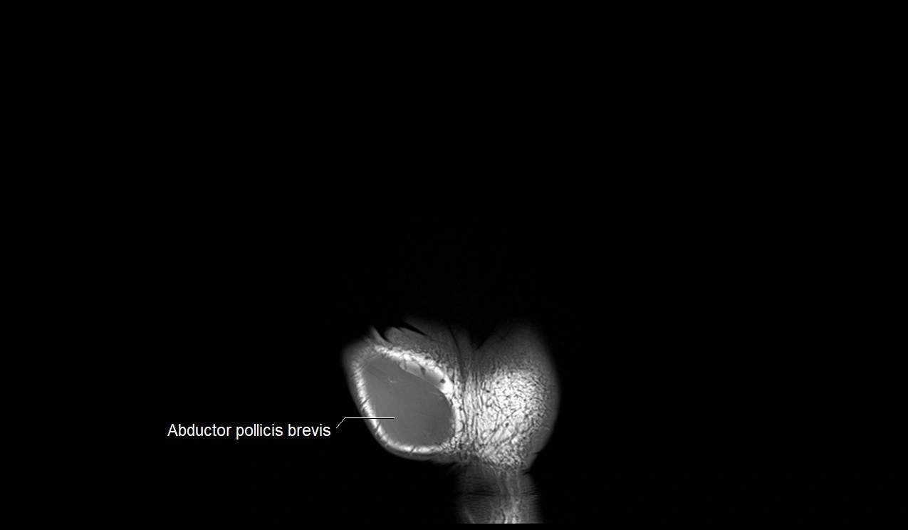 MRI 3T coronal hand cross sectional anatomy image 2.webp